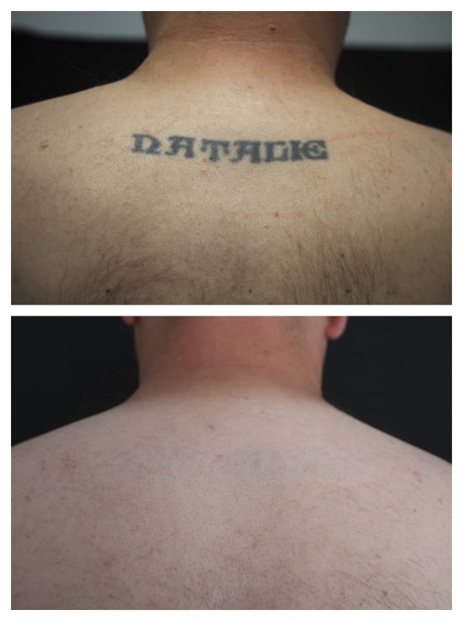 Why You Should Come To Us For Tattoo Removal - Laser NY
